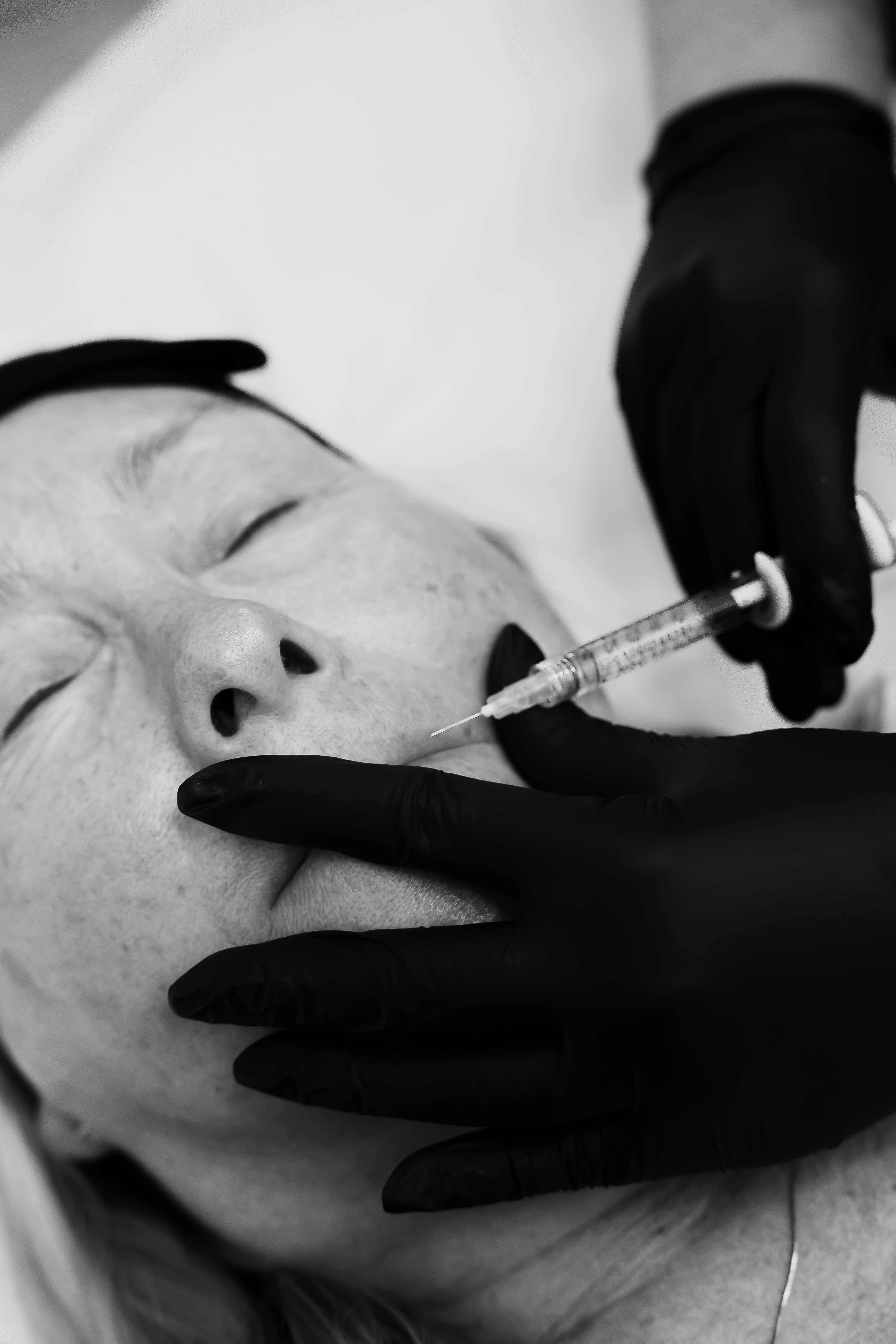 Dermal filler treatment at VISO Clinic, Bournemouth